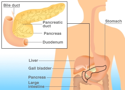 Nexweşiya Pancreatic: Nîşaneyên Nexweşiyê di nav mêr û jinan de