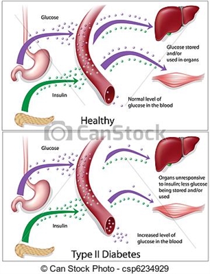 Dapagliflozin - 2-ci tip diabet xəstələri üçün dərman