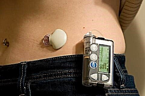 Kiel faras insulinpumpilon por diabeto