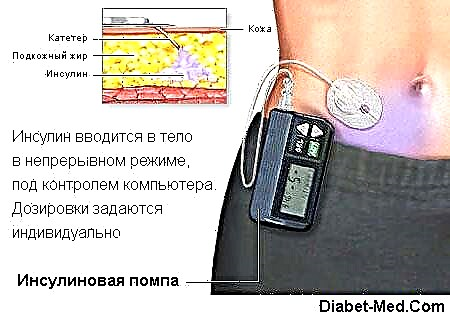 Insulin pump: kalamangan at kahinaan. Pump ng insulin therapy