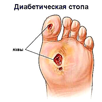ذیابیطس کے پاؤں کا سنڈروم: علامات ، نشانیاں اور علاج