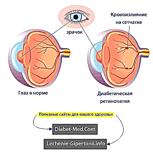 Diabeta retinopatio: etapoj, simptomoj kaj kuracado