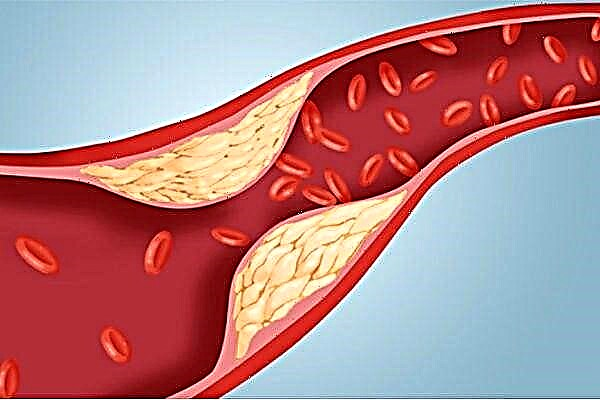 Diabetdə alt ekstremitələrin damarlarının aterosklerozunu aradan qaldırır