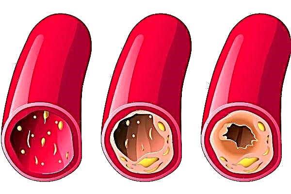 Atherosklerosis vun der Bauch Aorta: Wat ass et a wéi behandelt et?