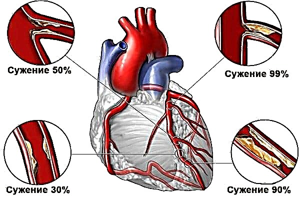 Atherosclerotic နှလုံးရောဂါ, aortic atherosclerosis: ကဘာလဲ
