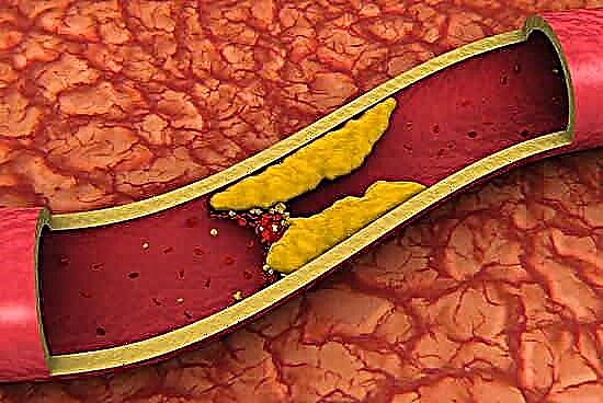 Атеросклероздың патогенезі: липидтер алмасуының бұзылуы