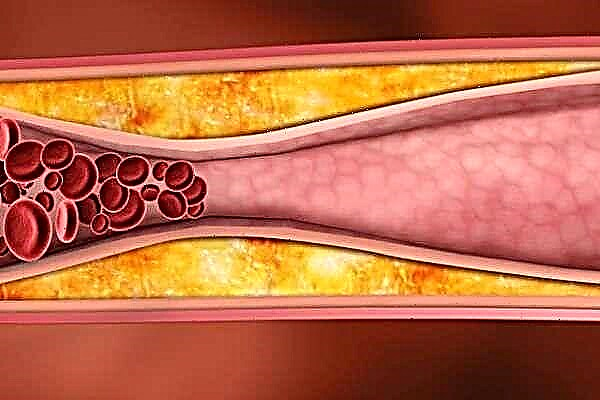 Cili është rreziku i presionit të ulët të gjakut në arteriosklerozë?