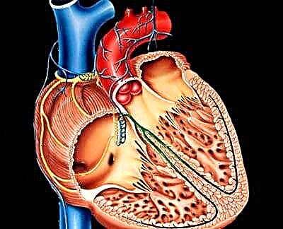 Cardi ye cardiosclerosis atherosclerotic: nîşanên û dermankirinê