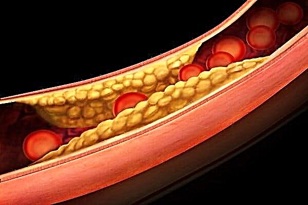 Атеросклерозын товрууны хөгжлийн үе шат