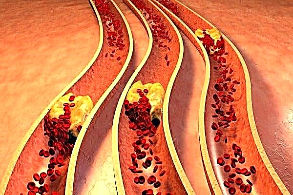 Atherosclerosis bagéan ékstrakranial tina arteri utama sirah