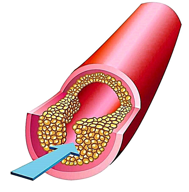 Атеросклероз: ересектердегі белгілер және емдеу