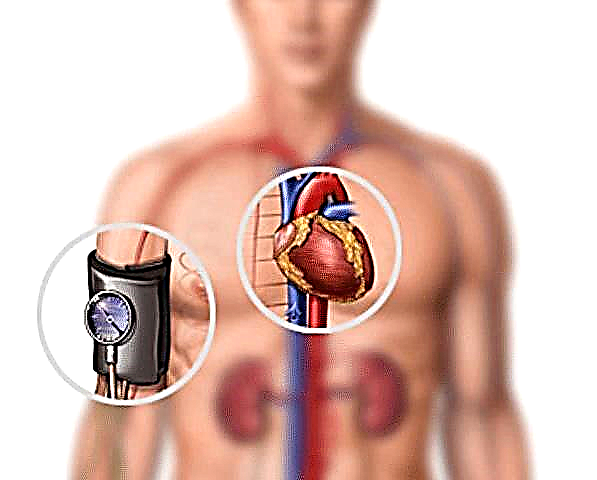 Üst ekstremitələrin damar aterosklerozu: simptomlar və müalicə