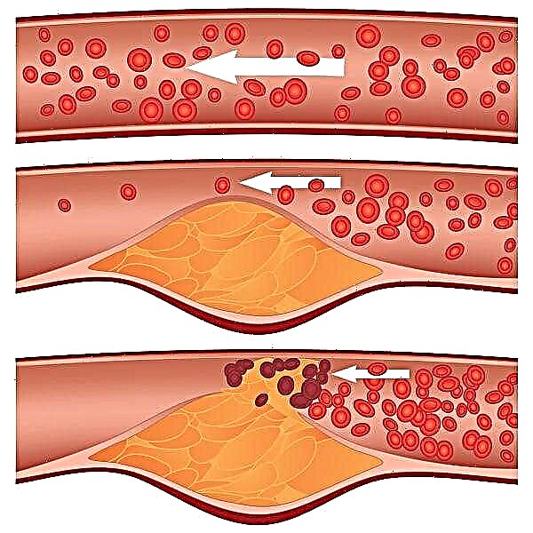 Maaari bang magkaroon ng atherosclerosis na may normal na kolesterol?