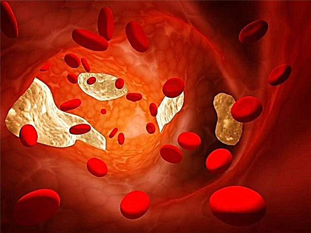 Suplemento para reducir o colesterol no sangue: unha lista de medicamentos eficaces