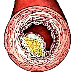 Kako liječiti holesterolne polipe u žučnoj kesici?