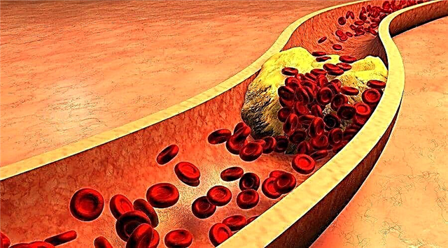 Kolesterol di nexweşiya şekir 2 de zêdebû ye: çawa wê kêm bike?