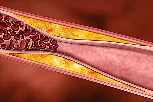 Kolesterol i keq: cili është ai dhe cila është norma e tij në një test gjaku?