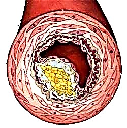 Kiel liberigi kolesterolo-plakojn en la karotida arterio?