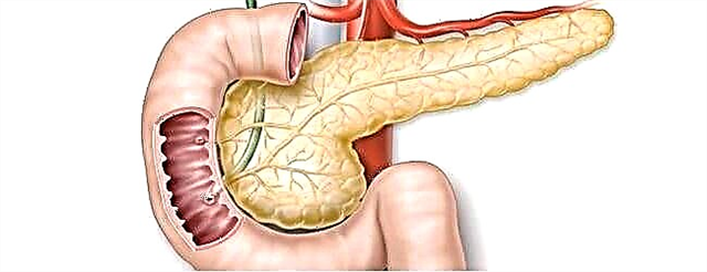 Symptomer vun Entzündung vun der gallbladder a Bauchspaicheldrüs: Medikamenter a Behandlung