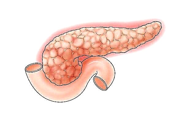 Steatorrhea, creatorrhea, amylorrhea: Ew bi pancreatitis re çi ye?