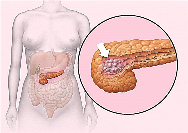 Pancreatic Insulinoma: Simptomoj kaj Traktado