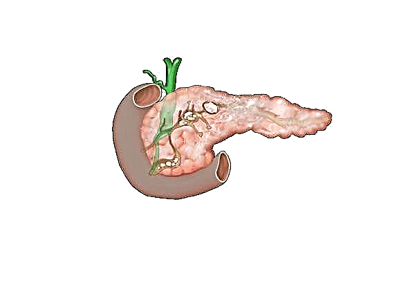 Panyabutan kista pancreatic: akibat tina operasi