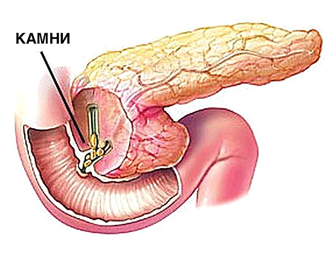 Pedra e area no páncreas: síntomas e tratamento