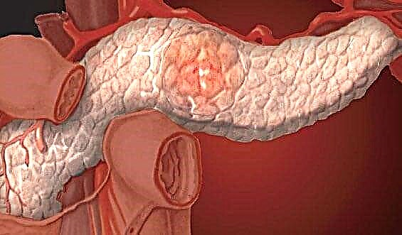 Malobservo de la interna sekrecio de la pankreato