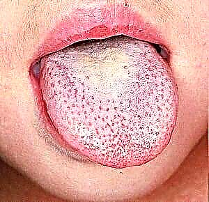 Die kleur van die tong met pankreatitis: fotoplak