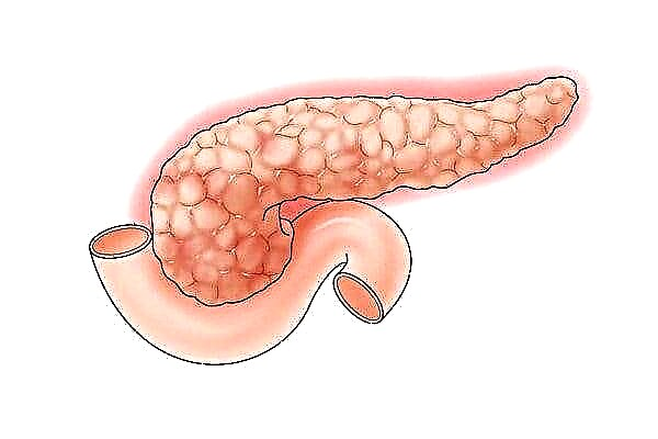Pankreata enzima manko: simptomoj kaj kuracado