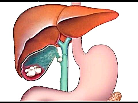 Nutrisyon alang sa sakit nga gallstone ug pancreatitis