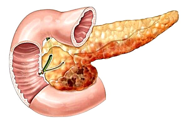 Pancreatic exocrine insufficiency syndrome: ndi chiyani?