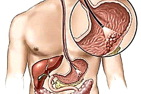 Paano alisin ang pancreatic edema sa bahay?