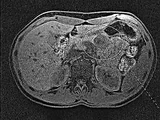 MRI ຂອງ pancreatic ສະແດງໃຫ້ເຫັນແນວໃດ?