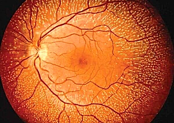 Diabeta angioretinopatio de la retino: kio estas la manifestiĝo de vidkapablo?