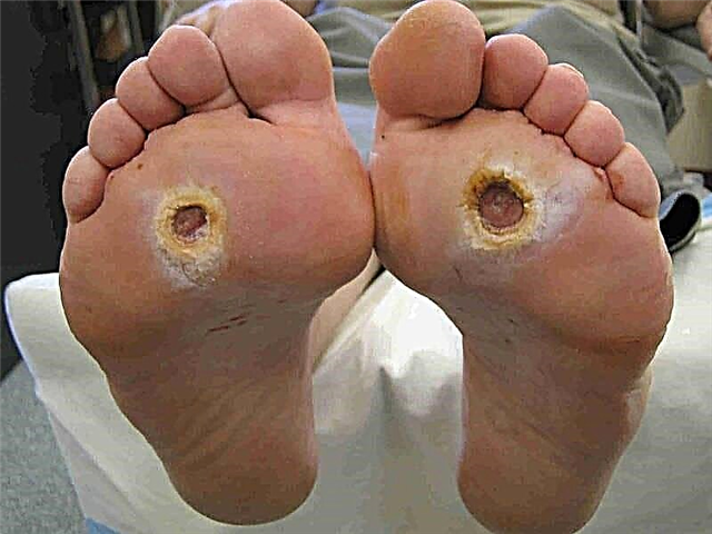 Phlegmon de la piedo en diabeto mellitus: foto kaj kuracado