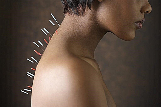 1 va 2-toifa diabet uchun akupunktur: biologik faol nuqtalar