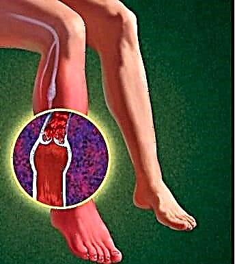 Чихрийн шижин өвчний үед хөлний өвчнөөс урьдчилан сэргийлэх