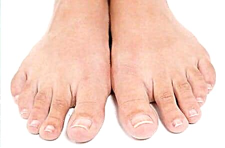 Gangrena stopala kod dijabetesa: fotografija nekroze prsta