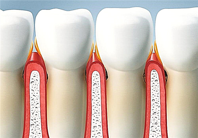 Чихрийн шижин дэх пародионтит: шүдний дутагдлын эмчилгээ
