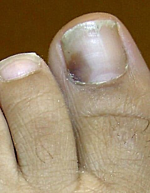 Дијабетичарот на ноктите има темни дамки: зошто прстите се црни?