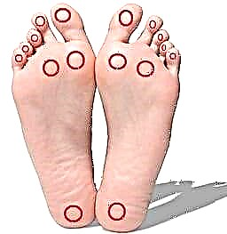 Pedicure fyrir sykursjúka: Foot care care