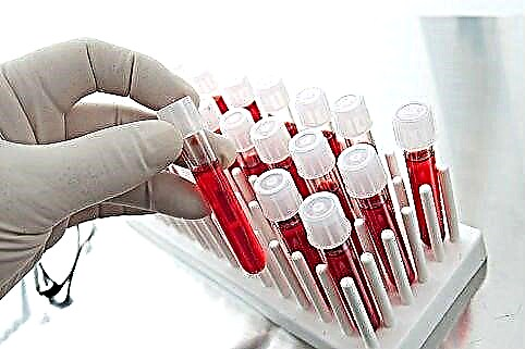 Metodat për diagnostikimin e diabetit: testet biokimike të gjakut