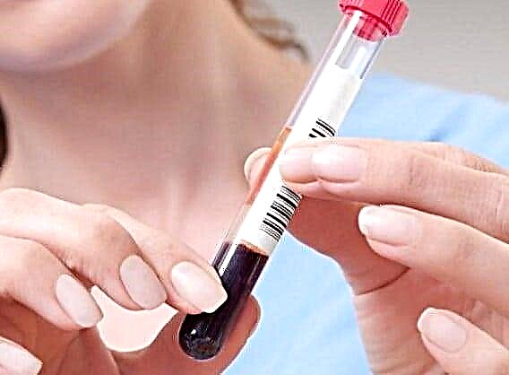 Shkalla e insulinës në gjakun e adoleshentëve në stomak bosh: cila është arsyeja e luhatjes së hormonit