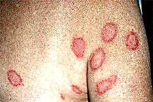 Eczema le haghaidh diaibéiteas: grianghraf den ghalar ar chraiceann diaibéitis agus cóireála