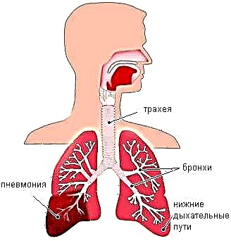 Pneumonia diabes: dermankirin û nîşanên tevlihevkirinê