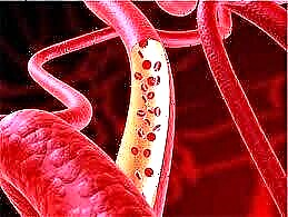 Кант диабетиндеги кан тамырлардын бузулушу: дары-дармектер жана дары-дармектер, бутту дарылоо