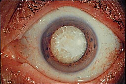 Чихрийн шижин өвчний харааны сулрал: нүдний торлог гэмтэл