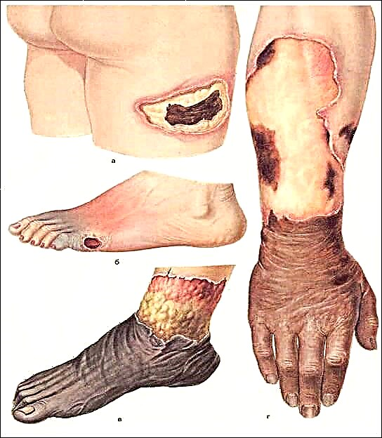 Amputasie by diabetes mellitus: bene, vinger, voet, gevolge van skade aan ledemate