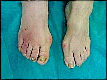 سوزش پاها در دیابت: درمان قرمزی انگشتان دست و پا